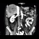 Hepatocellular carcinoma, HCC, gigantic: CT - Computed tomography